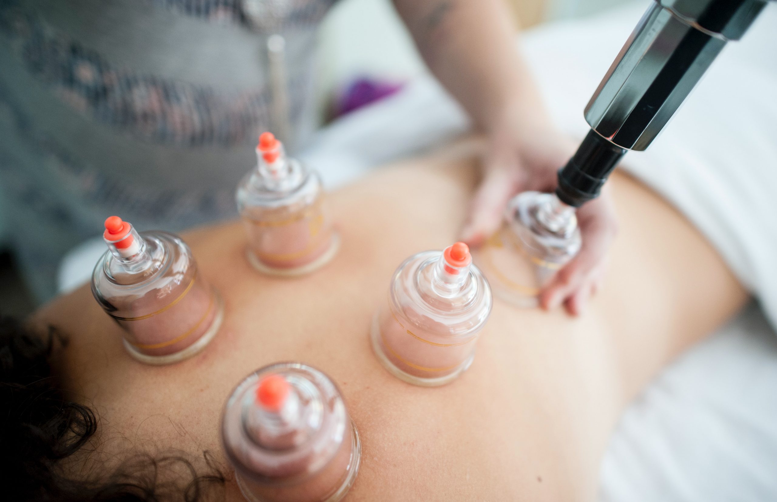 Hijama treatment cupping therapy benefits